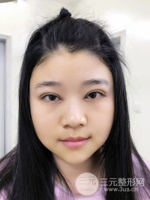 切開雙眼皮+開內(nèi)眼角真實案例，并附上前后對比圖片