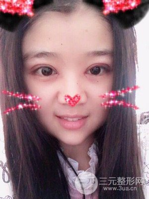 切開雙眼皮+開內(nèi)眼角真實案例，并附上前后對比圖片