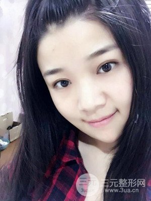 切開雙眼皮+開內(nèi)眼角真實案例，并附上前后對比圖片