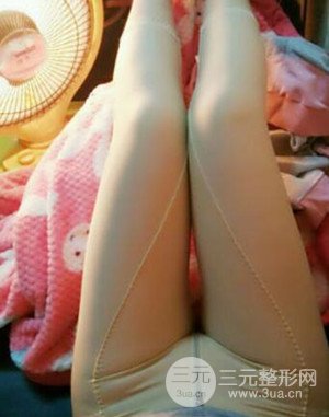 大腿抽脂案例 大腿抽脂前后對比圖