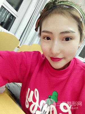 激光脫毛前后照片分享，真實案例~