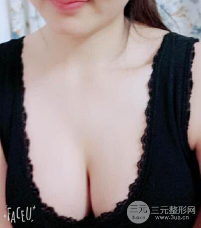 本人自體抽脂隆胸手術(shù)果很好價格案例