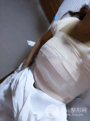 假體隆胸真實案例分享并附上前后對比圖片——襄陽維多利亞張世蓮醫(yī)生做的