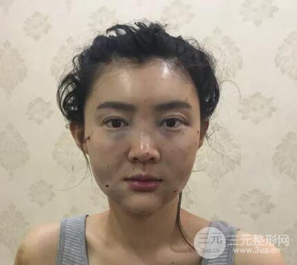 脂肪填充全臉恢復過程圖