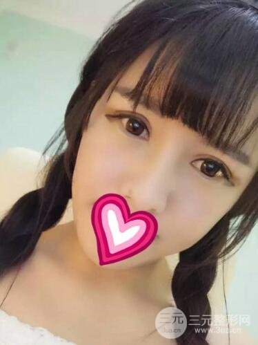 割雙眼皮失敗變幾層眼皮成功修復(fù)價格和案例分享