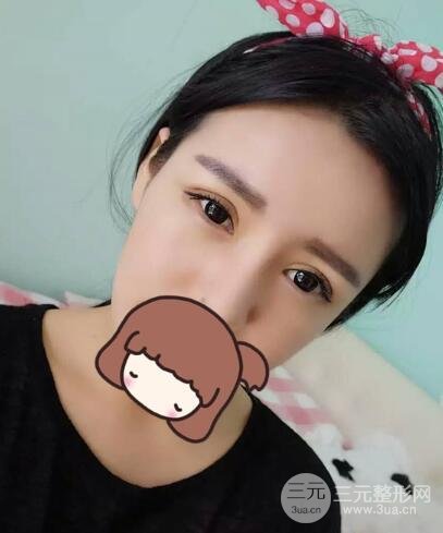 割雙眼皮失敗變幾層眼皮成功修復(fù)價格和案例分享