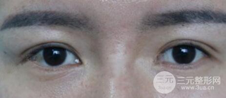 割雙眼皮失敗變幾層眼皮成功修復(fù)價格和案例分享