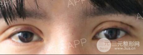 割雙眼皮失敗變幾層眼皮成功修復(fù)價格和案例分享