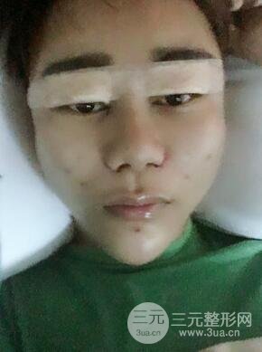 切開雙眼皮+自體脂肪填充全臉真實(shí)案例分享，并附上前后對(duì)比圖片~