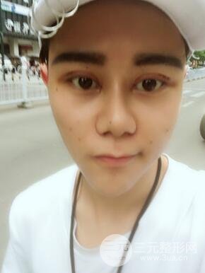 切開雙眼皮+自體脂肪填充全臉真實(shí)案例分享，并附上前后對(duì)比圖片~