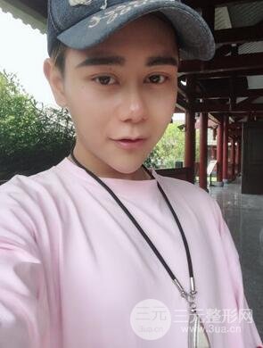 切開雙眼皮+自體脂肪填充全臉真實(shí)案例分享，并附上前后對(duì)比圖片~