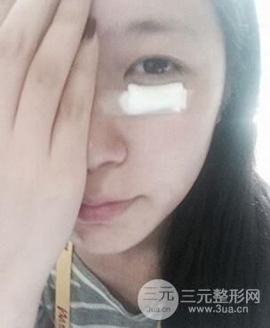 內(nèi)切祛眼袋手術(shù)真實(shí)案例，并附上前后對(duì)比圖片