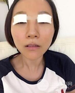 武漢葉子竺湘云給我做的切開雙眼皮手術(shù)，分享一下前后對比圖片