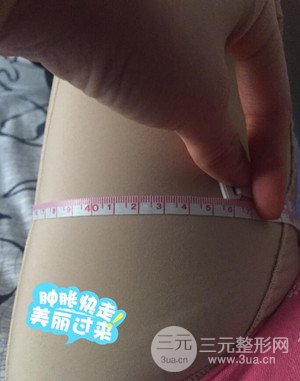 大腿吸脂前后對比圖以及恢復(fù)過程分享——武漢葉子竺湘云醫(yī)生做的