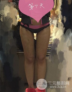 大腿吸脂前后對比圖以及恢復(fù)過程分享——武漢葉子竺湘云醫(yī)生做的