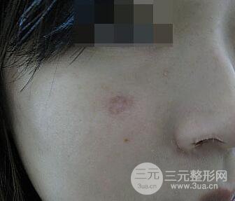激光祛疤非手術(shù)真實(shí)果圖案例