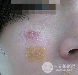 激光祛疤非手術(shù)真實(shí)果圖案例