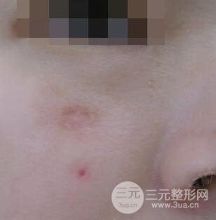 激光祛疤非手術(shù)真實(shí)果圖案例