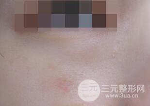 激光祛疤非手術(shù)真實(shí)果圖案例
