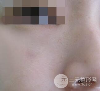 激光祛疤非手術(shù)真實(shí)果圖案例