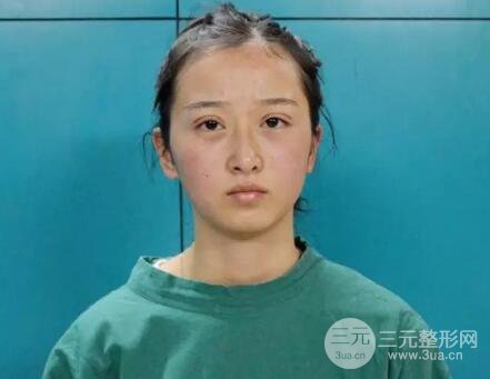 武漢天申朱天申切開(kāi)雙眼皮真實(shí)案例，附上前后對(duì)比圖片