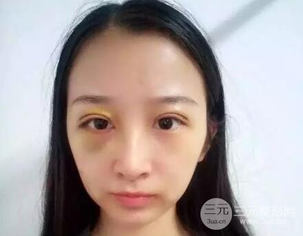 武漢天申朱天申切開(kāi)雙眼皮真實(shí)案例，附上前后對(duì)比圖片