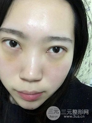 內(nèi)切祛眼袋手術(shù)真實(shí)案例，武漢天申胡麗醫(yī)生做的