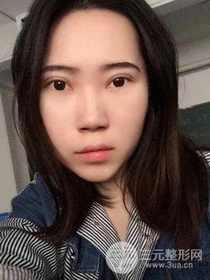 內(nèi)切祛眼袋手術(shù)真實(shí)案例，武漢天申胡麗醫(yī)生做的