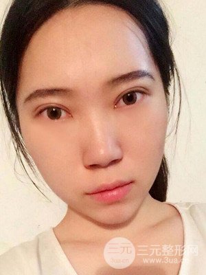 內(nèi)切祛眼袋手術(shù)真實(shí)案例，武漢天申胡麗醫(yī)生做的