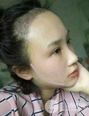 武漢天申胡麗醫(yī)生發(fā)際線種植真實(shí)案例，并附上前后對比圖片