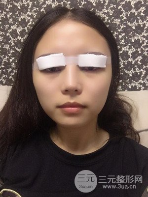 　全切雙眼皮真實案例分享，武漢一美汪國民醫(yī)生做的