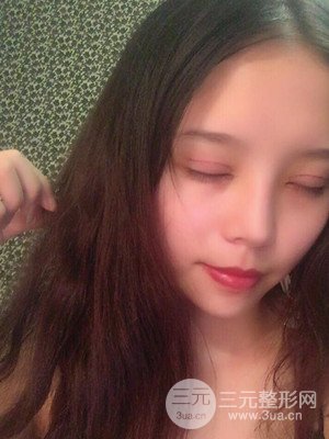 　全切雙眼皮真實案例分享，武漢一美汪國民醫(yī)生做的