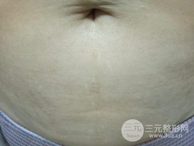 武漢一美王朝暉激光去妊娠紋真實(shí)案例，并附上前后對(duì)比圖片