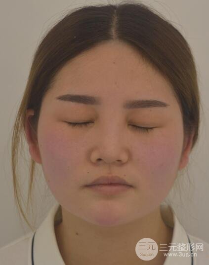 全切開雙眼皮價格和恢復(fù)過程對比圖片