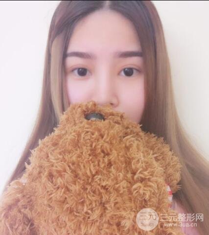 全切開雙眼皮價格和恢復(fù)過程對比圖片