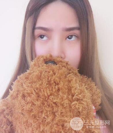 全切開雙眼皮價格和恢復(fù)過程對比圖片