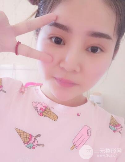 全切開雙眼皮價格和恢復(fù)過程對比圖片