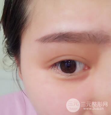 全切開雙眼皮價格和恢復(fù)過程對比圖片