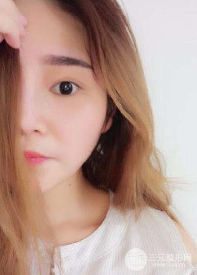 全切開雙眼皮價格和恢復(fù)過程對比圖片