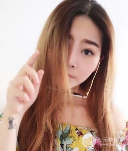 全切開雙眼皮價格和恢復(fù)過程對比圖片