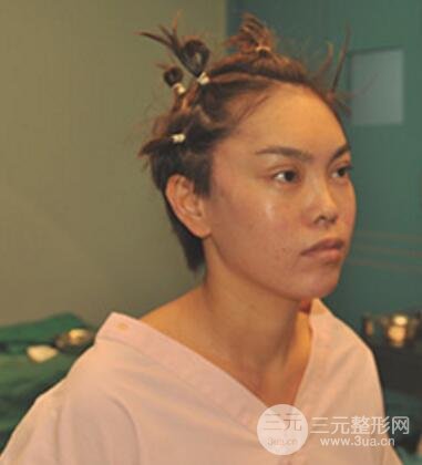 去做了埋線面b提拉術(shù)果很是不錯(cuò)