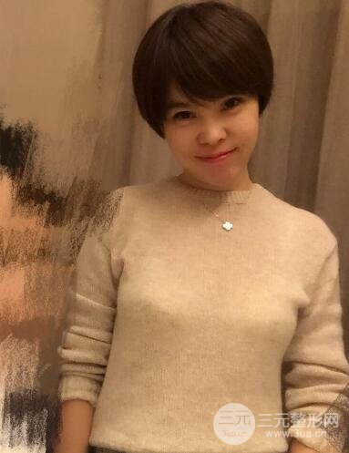 去做了埋線面b提拉術(shù)果很是不錯(cuò)