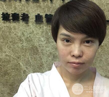 去做了埋線面b提拉術(shù)果很是不錯(cuò)