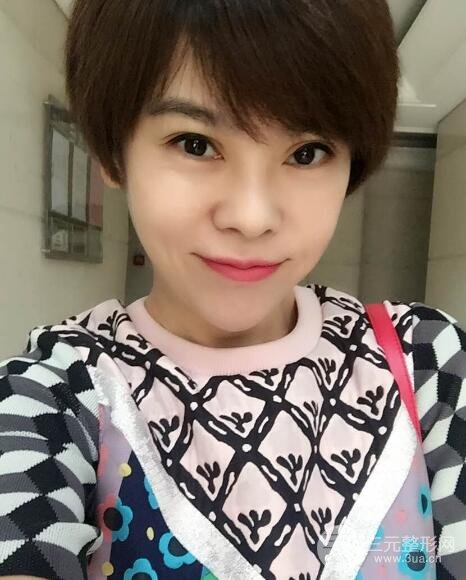 去做了埋線面b提拉術(shù)果很是不錯(cuò)