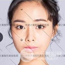 面部自體脂肪填充+隆鼻整形+雙眼皮案例，恢復(fù)果照片~