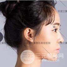 面部自體脂肪填充+隆鼻整形+雙眼皮案例，恢復(fù)果照片~