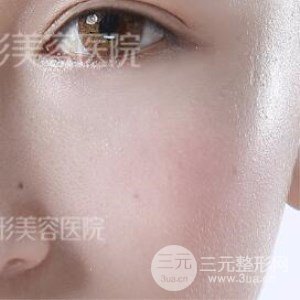 芭比雙眼皮+去眼袋案例分享，還有恢復(fù)過程照片哦~