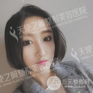 芭比雙眼皮+去眼袋案例分享，還有恢復(fù)過程照片哦~