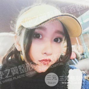 芭比雙眼皮+去眼袋案例分享，還有恢復(fù)過程照片哦~