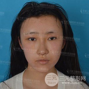 自體脂肪面部填充+全鼻金雕真實案例，恢復(fù)照片分享~